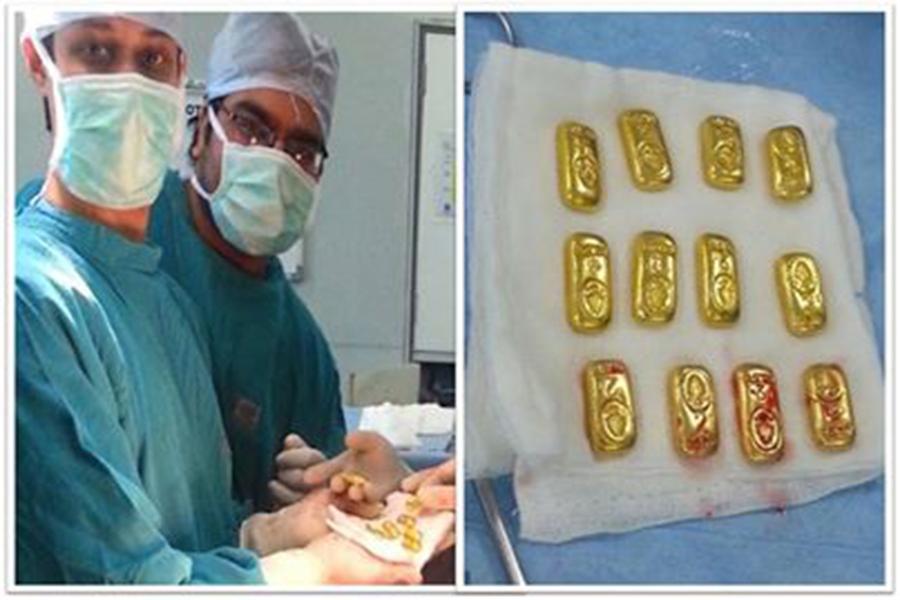 Gold Bars Found In Man's Stomach